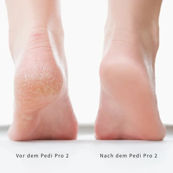 Pedi Pro 2 – Seidig weiche Füße in Sekunden
